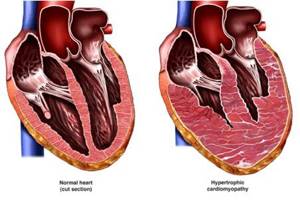 гипертрофия миокарда левого желудочка сердца что это такое