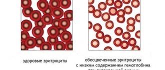 Гипохромия в общем анализе крови у ребенка, женщин, мужчин, причины, лечение