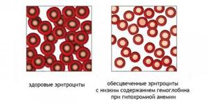 Гипохромия в общем анализе крови у ребенка, женщин, мужчин, причины, лечение