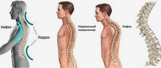Грудной кифоз
