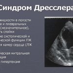 Характерные признаки Синдрома Дресслера