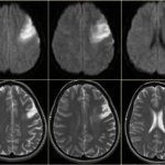 Хроническая ишемия