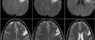 Хроническая ишемия