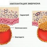 Имплантационное кровотечение. Фото, что это такое, у всех ли бывает, когда делать тест на беременность, на какой день происходит после переноса эмбрионов