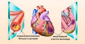 Инфаркт миокарда при низком давлении