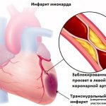 Инфаркт миокарда