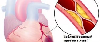 Инфаркт миокарда