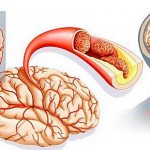 Инсульт как причина сосудистой деменции