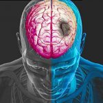 ишемический и геморрагический инсульт