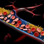 Ишемический инсульт левого полушария