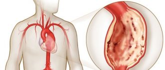 Ишемия аорты лечение - Все про гипертонию
