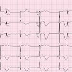 Ишемия на ЭКГ: признаки, классификация и лечение