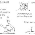Искусственное дыхание. Как делать, что это, способы, правила, признаки успешного проведения, виды