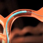 Избавление от тромба