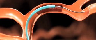 Избавление от тромба