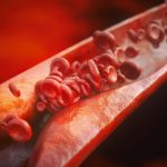 как лечить атеросклероз сосудов нижних конечностей