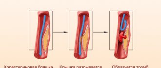 How does myocardial infarction occur?