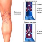 Какие болезни лечит флеболог