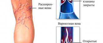 Какие болезни лечит флеболог