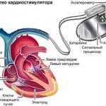 Кардиостимулятор. Что это такое, виды, как работает, сколько стоит, операция по установке, жизнь с ним