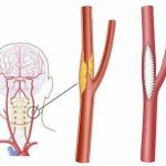 каротидная эндартерэктомия