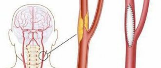 каротидная эндартерэктомия
