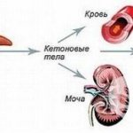 Кетоацидоз – неотложное состояние, связанное с накоплением в крови кетоновых тел