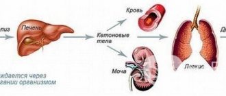 Кетоацидоз – неотложное состояние, связанное с накоплением в крови кетоновых тел