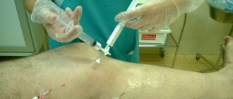 Venous valve role and structure