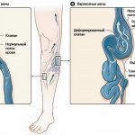 Клапанная недостаточность вен нижних конечностей