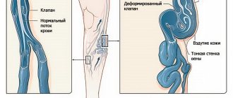 Клапанная недостаточность вен нижних конечностей