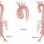 классификация расслоения аорты