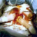 коронарное шунтирование сосудов сердца