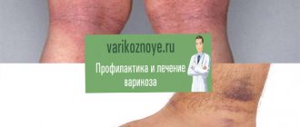 красные и синие пятна на ноге