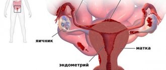 Кровотечение после месячных: причины