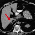 КТ брюшной полости