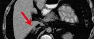 КТ брюшной полости