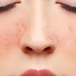 купероз на носу и лице