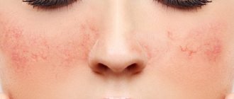 купероз на носу и лице