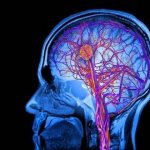 Лакунарный ишемический инсульт головного мозга прогноз