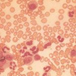 ЛДГ в крови - что это такое