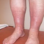 Лечение посттромбофлебитического синдрома ног