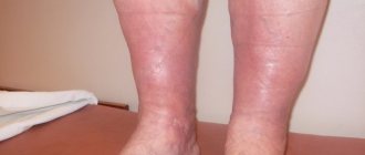 Treatment of postthrombophlebitic leg syndrome