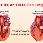 Левый желудочек сердца увеличен
