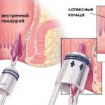 Ligation of hemorrhoids
