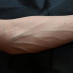 burst blood vessel on the wrist