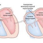 Малые аномалии сердца