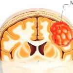 Менингиома головного мозга
