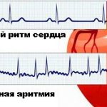 Мерцательная аритмия