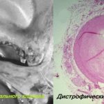 Метастатический кальциноз аортального клапана и дистрофический кальциноз коронарной артерии